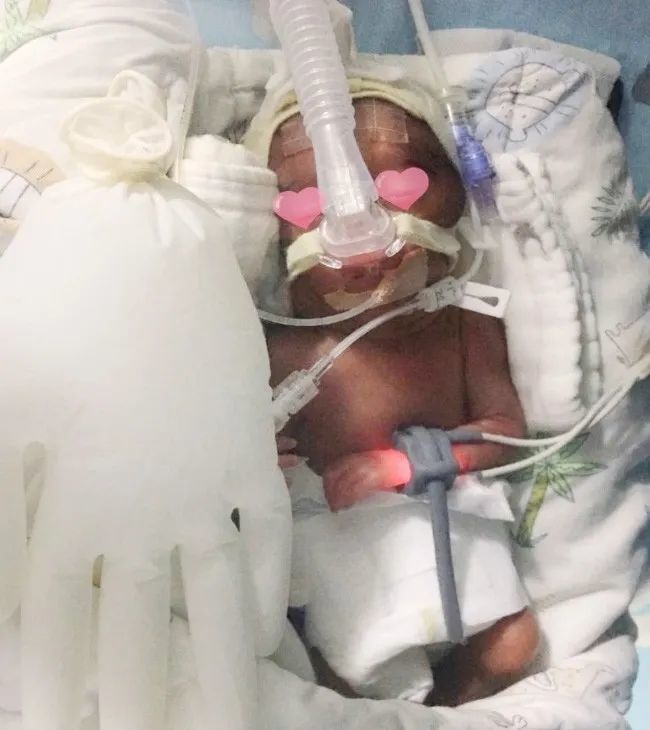 25周早产超低重700克巴掌大的龙凤胎历经4个月生命闯关终于出院啦