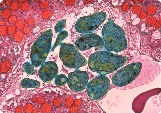 弓形虫病|血清弓形虫IgM抗体阳性，CD4小于等于200的艾滋病人，具高危险性