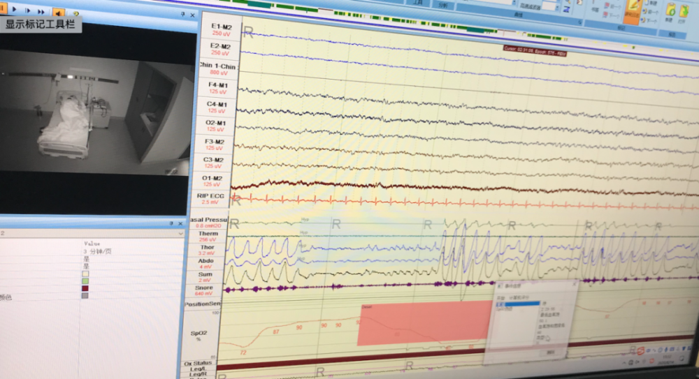 血氧饱和度跌到60,脑电波发生紊乱,憋气导致醒转对于睡眠障碍年轻化的