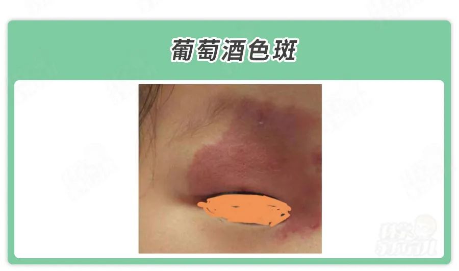 图片来源:科学家庭育儿原创 葡萄酒色斑 名字很好听,样子却很吓人