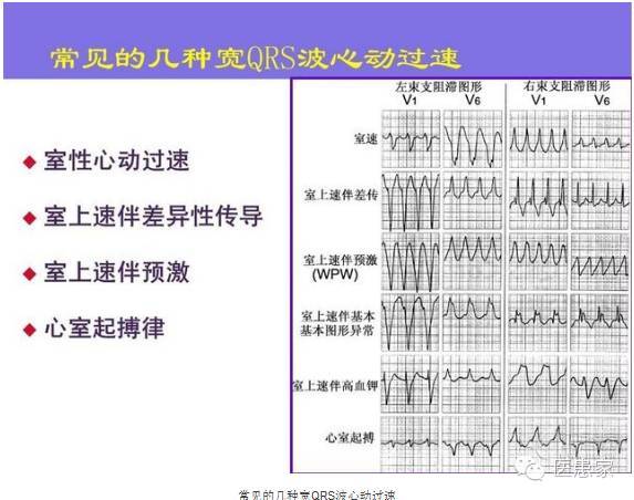 血液动力学鉴别(2)宽qrs心动过速发生在上述病史之后,室速可能性较大