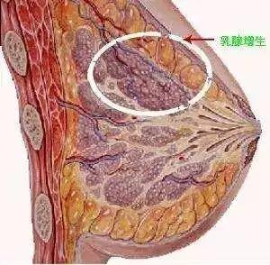 非典型乳腺增生与乳腺癌风险—那些你不了解的关系