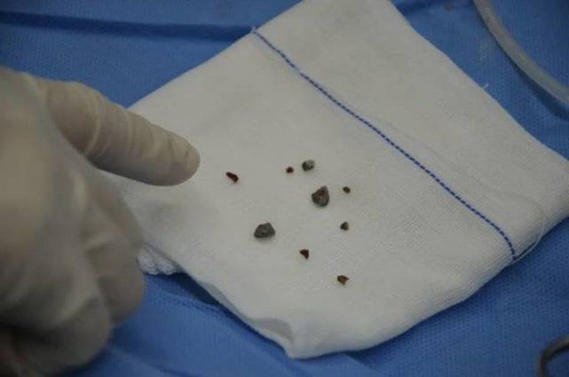 6×0.4cm大小的结石.