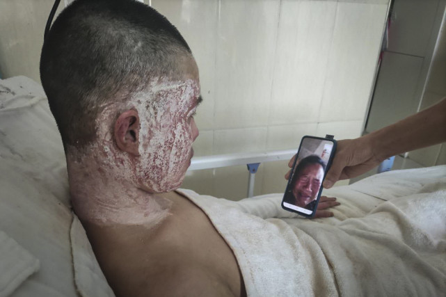 河南一14岁少年心脏手术后又遭重度烧伤,父亲"一夜"白头