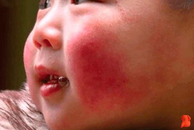 秋季到来宝宝脸蛋变得又红又糙如何做好宝宝的面子工程