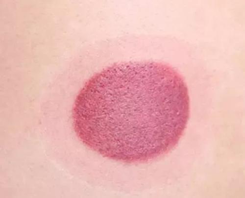 拔罐后不同印记代表什么你拔罐后出现什么颜色的印记