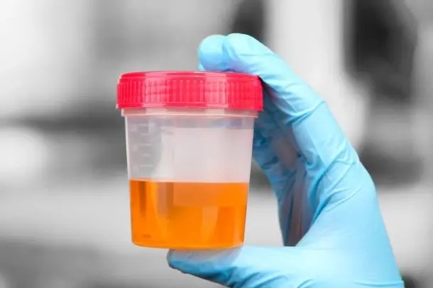 体检查出镜下血尿怎么办 镜下血尿离癌症有多远 腾讯新闻