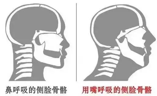 科普專家答疑切除腺樣體扁桃體會影響孩子的免疫力嗎