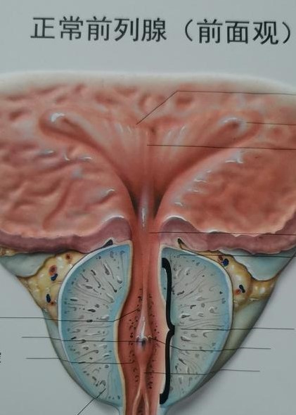 慢性前列腺炎為何難治