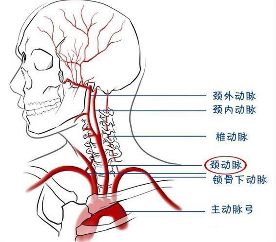 有颈动脉斑块的人还能跑步吗斑块脱落会堵塞血管吗