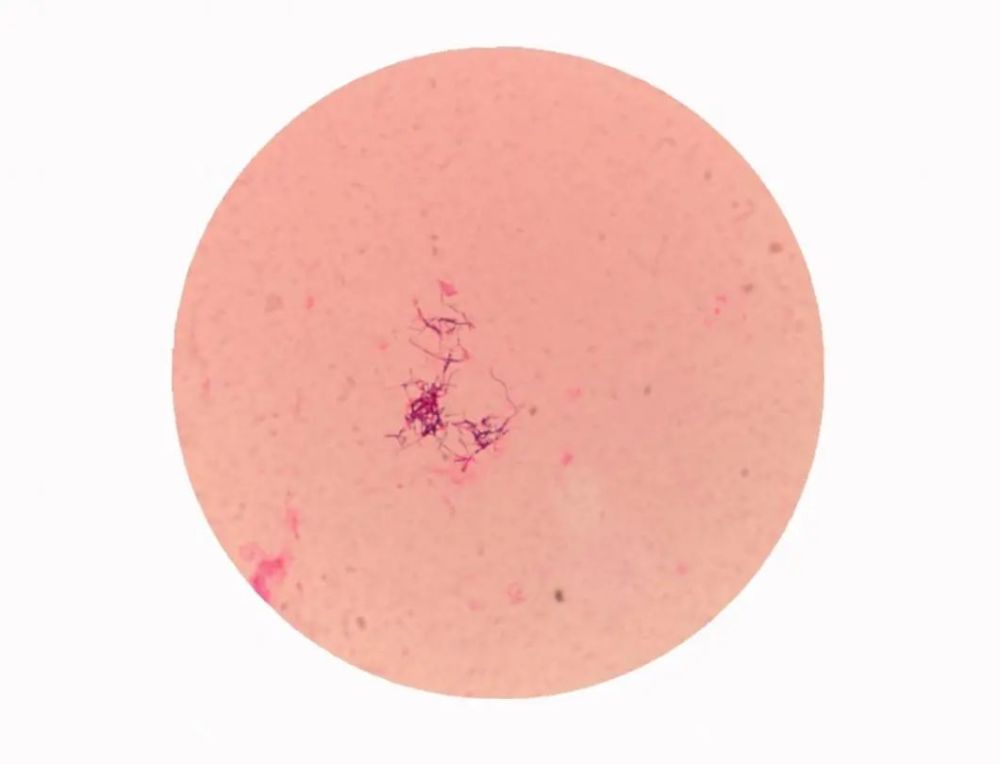 产妇不明原因发热究竟为何