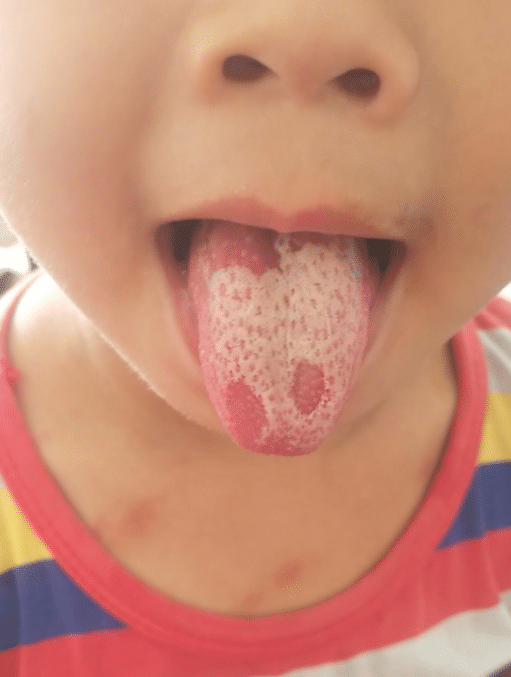 小孩舌头上一块一块的图片
