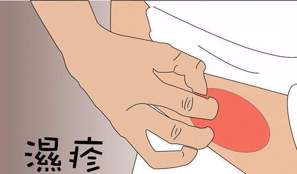 湿疹|长湿疹是因为湿气重吗？身体容易长湿疹的原因