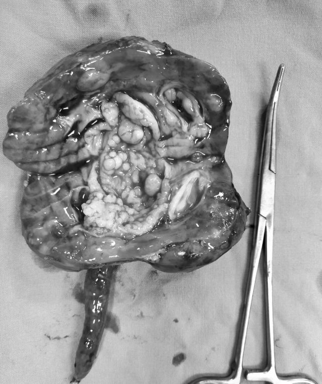 小儿肾母细胞瘤是小儿发病率最高的实体瘤,只要早期发现,及时规范治疗