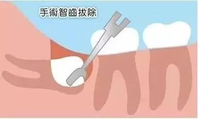 拔智齒後幾天可以刷牙