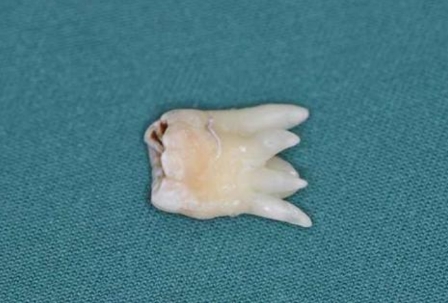 不拔智齿的好处有哪些