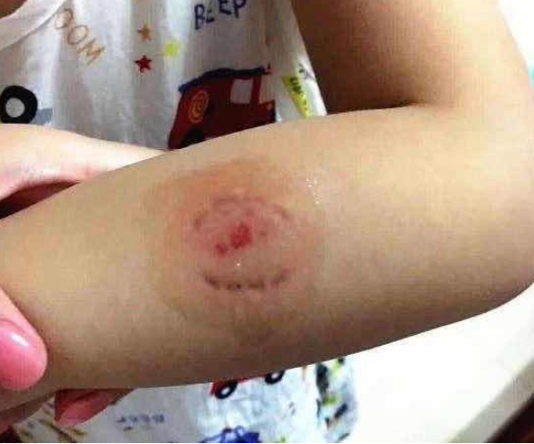孩子手臂被咬出血,宝妈不吵闹从源头解决问题,家长:我咋没想到