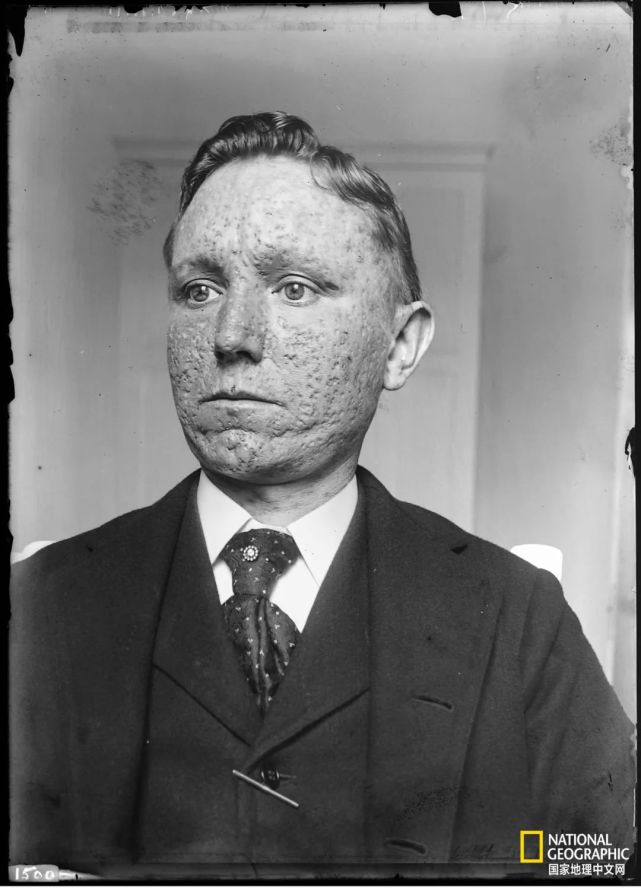 天花,病毒界的天花板