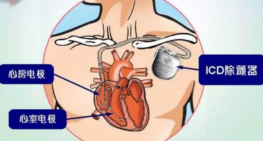 心臟性猝死的救命神器:icd