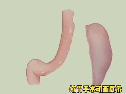 杨天真|杨天真晒手术视频，肚子上打四个洞自己签字，无家人陪伴惹人心疼