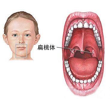 宝宝总是扁桃体发炎 有什么好的方式治愈 腾讯新闻