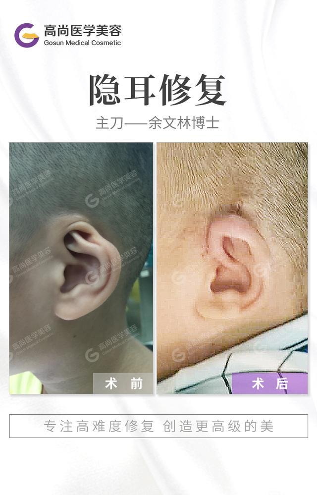 孩子隐耳怎么矫正?用什么方法好?余文林解答