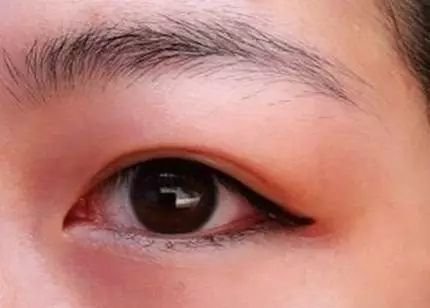 郑明明您告诉您|眼睛浮肿|郑明明|黑眼圈|眼睑下垂