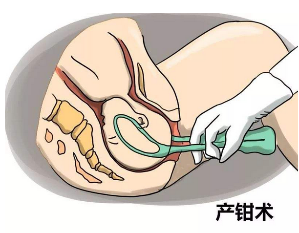 "医生,能别用产钳吗",产妇忍痛换跪姿分娩,护士感慨为母则刚