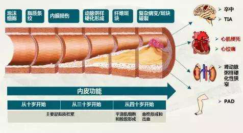 动脉硬化|是什么导致的动脉粥样硬化？