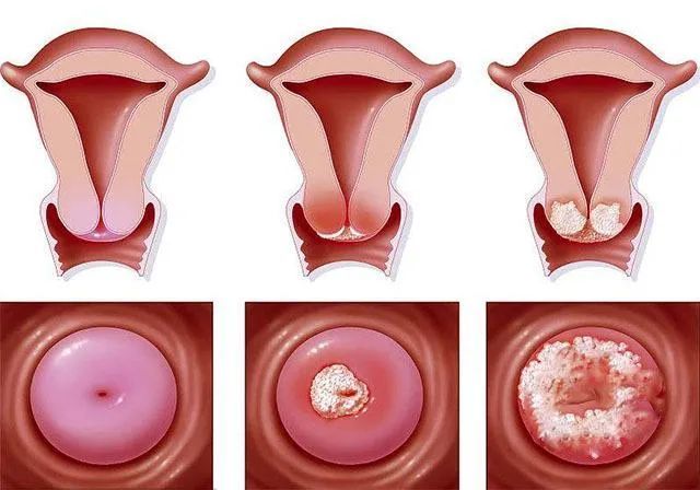 身为女人,一定要呵护好子宫的内环境,排毒素 祛寒湿,非艾灸莫属!
