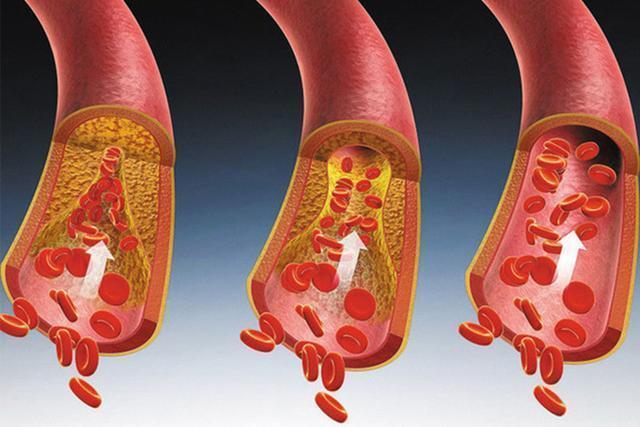 血液粘稠的4个表现，“少做3事，多吃4物”，让你血管不堵塞
