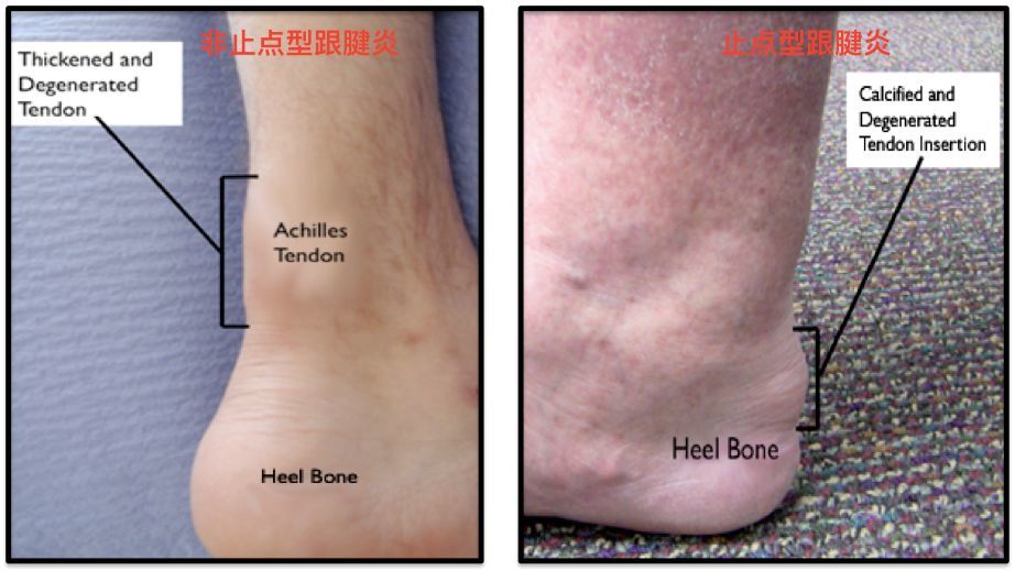 跟腱炎的两类人如果是运动员或者是重体力劳动者,在劳累以后症状就会