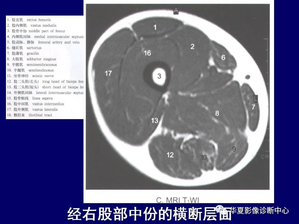 小腿肌肉解剖MRI图片