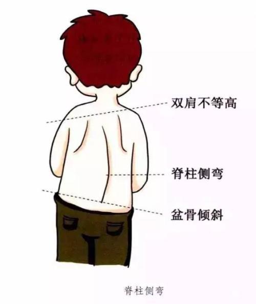 青少年脊柱侧弯是什么?如何进行治疗?