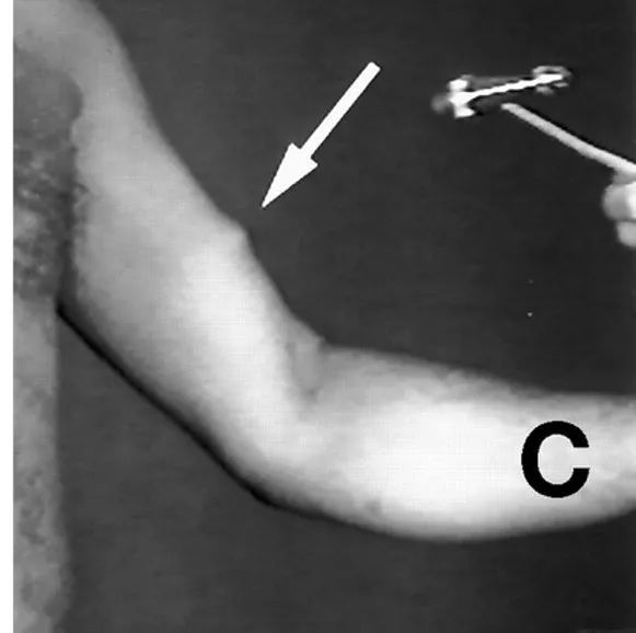 肌肉|网红猛男的跳舞肌肉引发围观，但他其实患上了罕见病