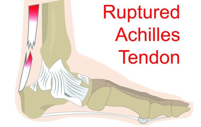 太伤 爱运动的你 一定要保护好这个部位 跟腱损伤 跟腱断裂 易建联
