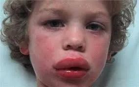 零食|全澳紧急召回！这款热卖零食，看到千万注意！有过敏风险！购入可全额退款！