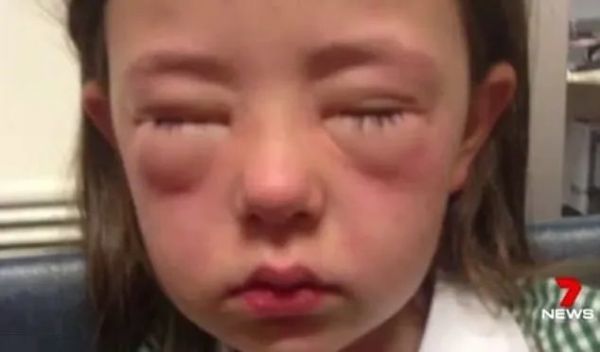 零食|全澳紧急召回！这款热卖零食，看到千万注意！有过敏风险！购入可全额退款！