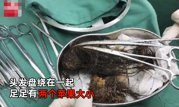 女童腹痛3个月医生剖开肚子取出的东西让人后怕图