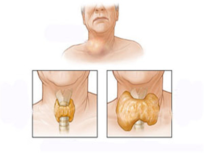 之柔软,光滑,时间长了,肿块会变硬,早期的时候患者一般没有明显的症状