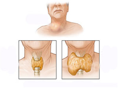 瘿病作妖?如何消除?