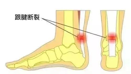 跑步跟腱疼怎么办不做好这5点可能再也不能跑了