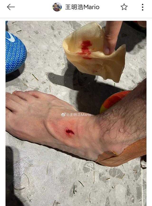 争议国脚飞铲引争议对手脚面踩出血洞需缝针小腿划出一道印痕