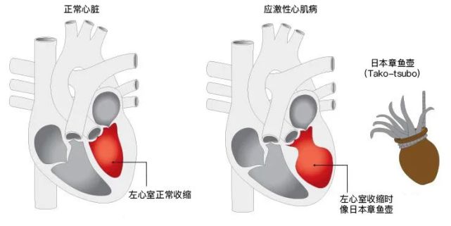 应激性心肌病心脏图示