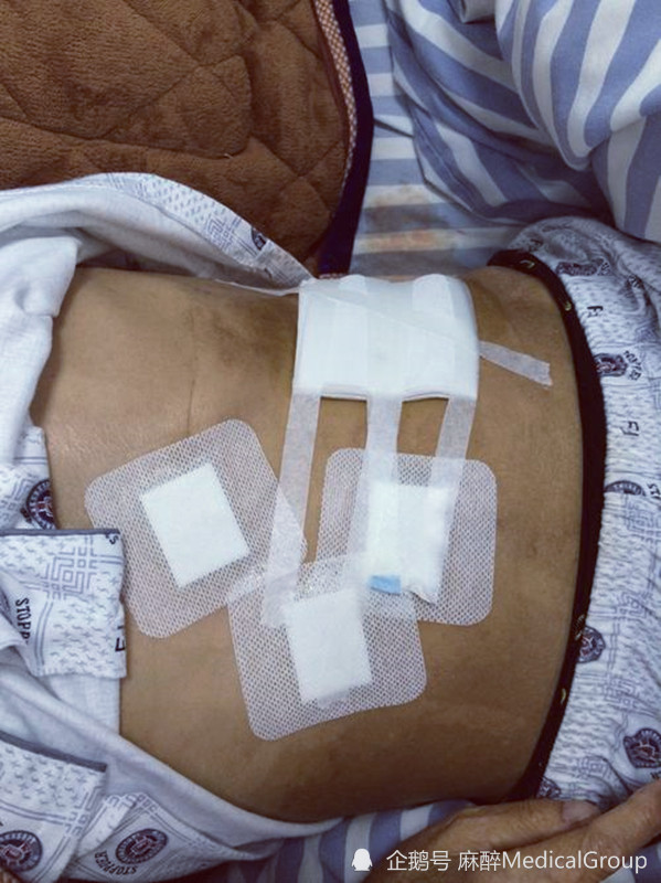 如何预防腹腔镜手术后的疼痛