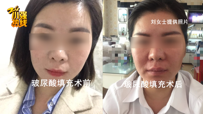 杭州芘丽芙医疗美容医院整形失败？刘女士：感觉要得抑郁