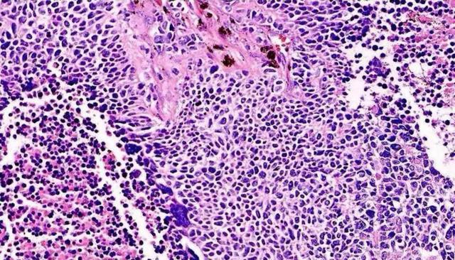 倍增时间大约30-60天),所以分布很密集,像燕麦一样(曾用名燕麦细胞癌)