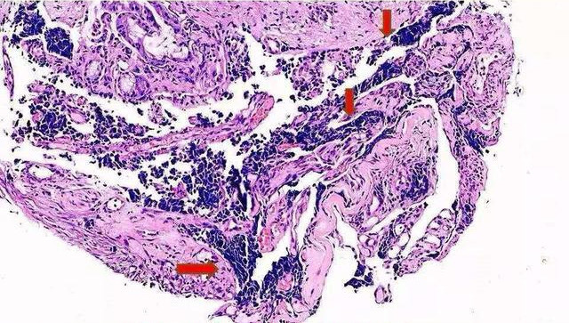 小细胞肺癌是怎么发生的?为何只有5%能早期手术?