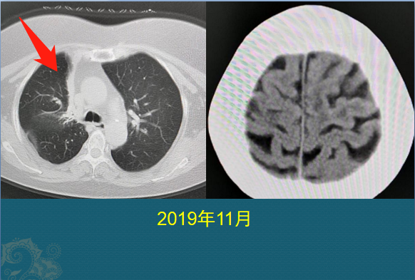 小细胞肺癌是怎么发生的?为何只有5%能早期手术?