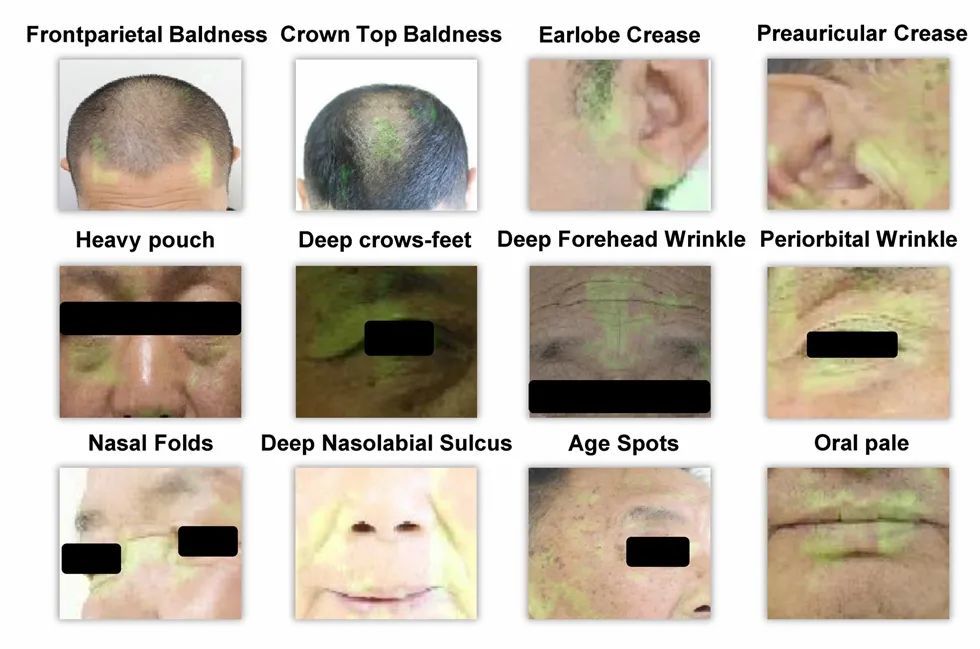 牛津大学|自拍就能识别冠心病！阜外、清华合作成果发表，牛津专家点赞诊断潜力